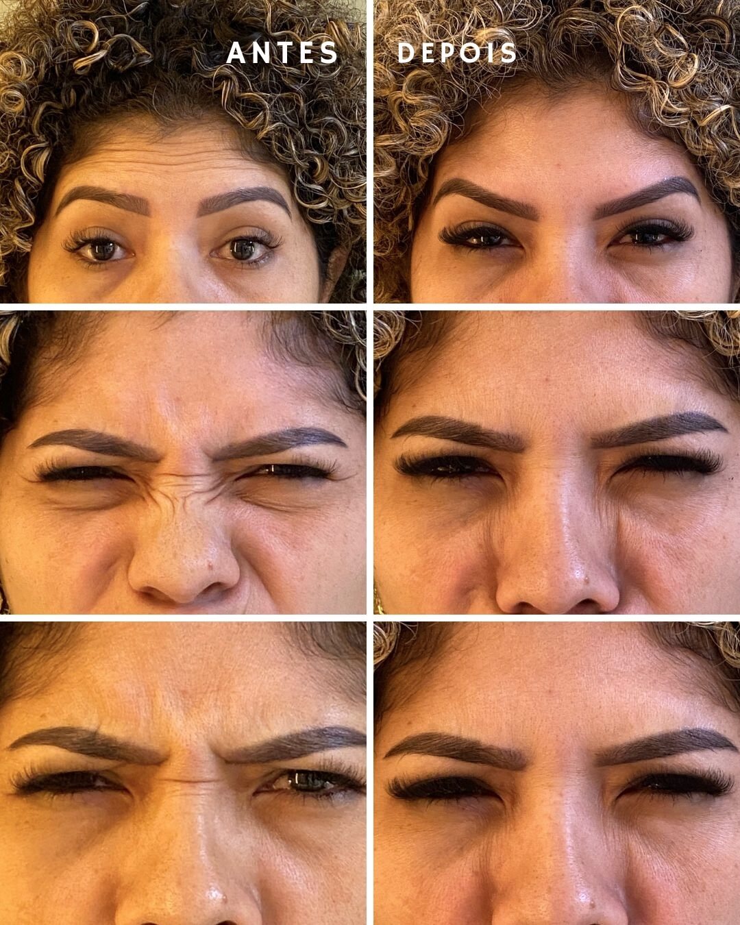 Antes e depois de toxina botulínica (com autorização da paciente)