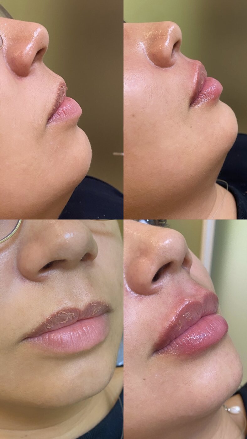 Antes e depois de preenchimento labial (com autorização da paciente)
