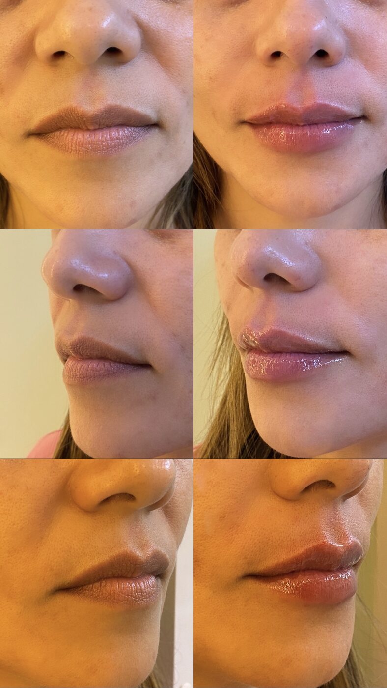 Antes e depois de contorno labial (com autorização da paciente)