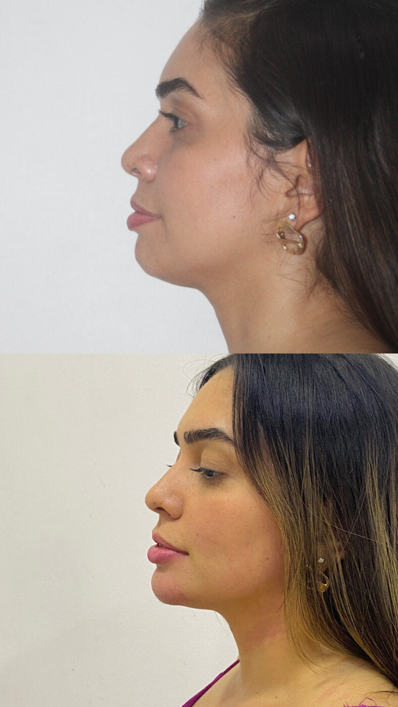Antes e depois de harmonização de perfil (com autorização da paciente)