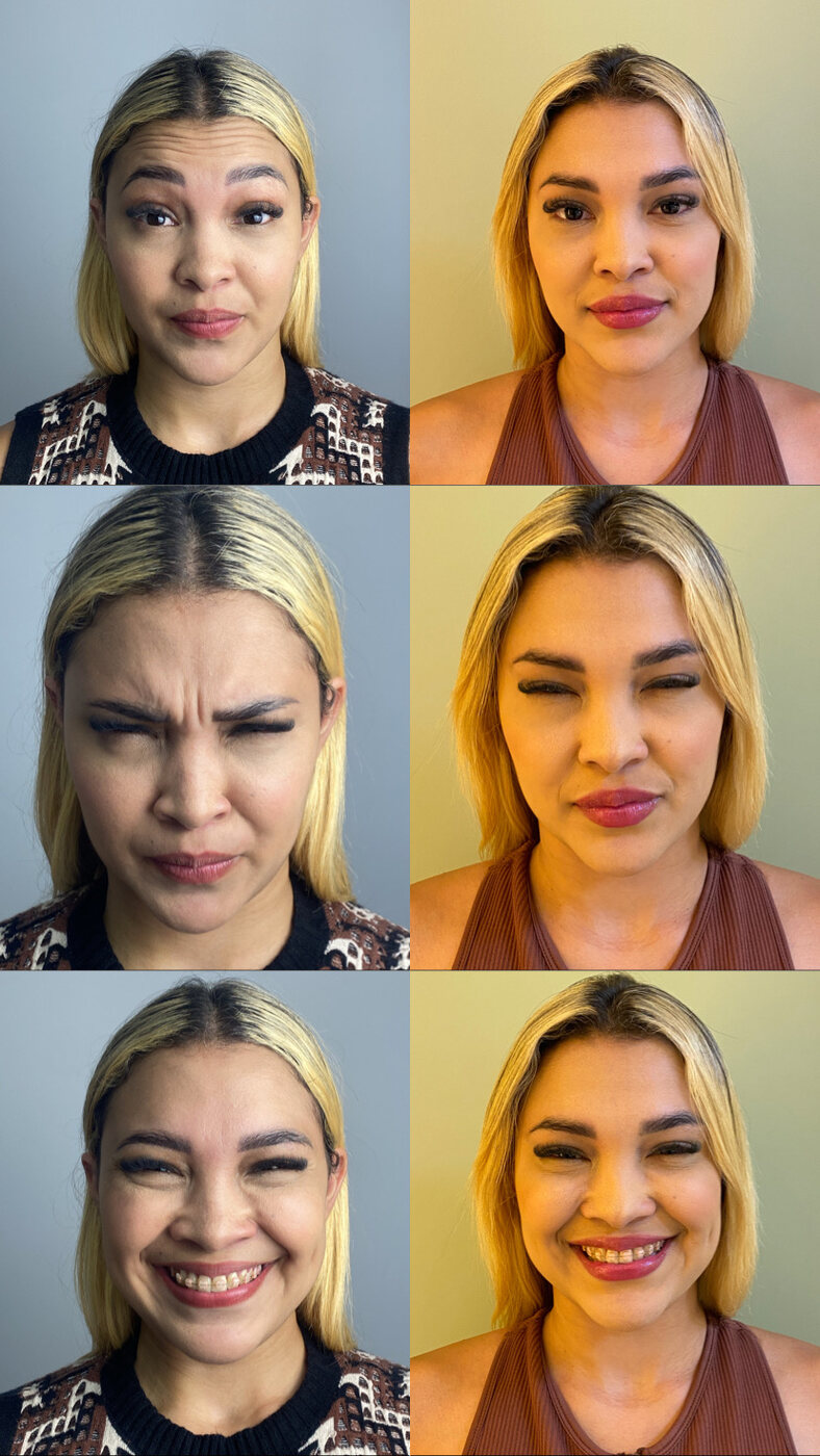 Antes e depois de toxina botulínica em Santarém — Franzir e expressão (imagem publicada com autorização do paciente)