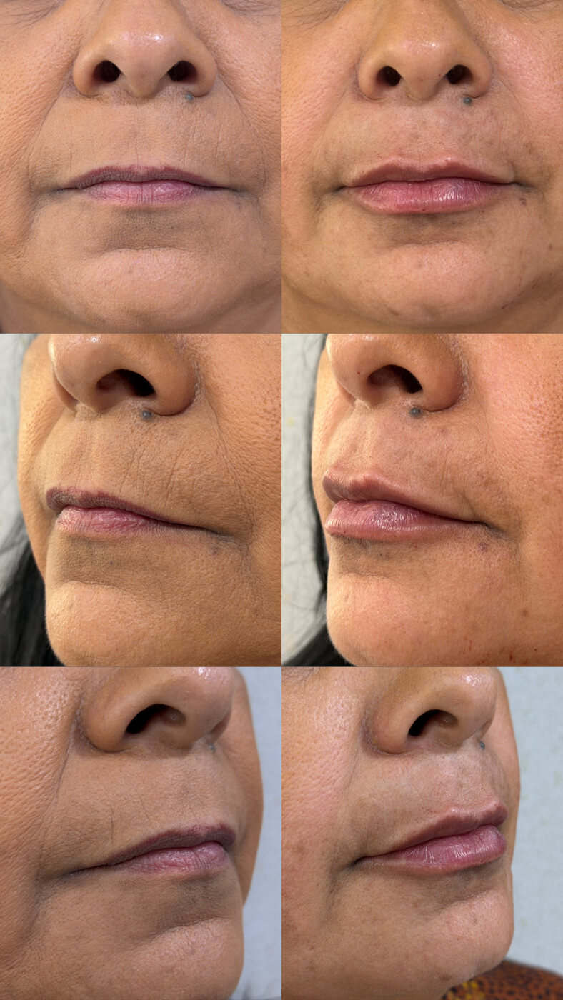 Antes e depois de preenchimento facial (com autorização da paciente)